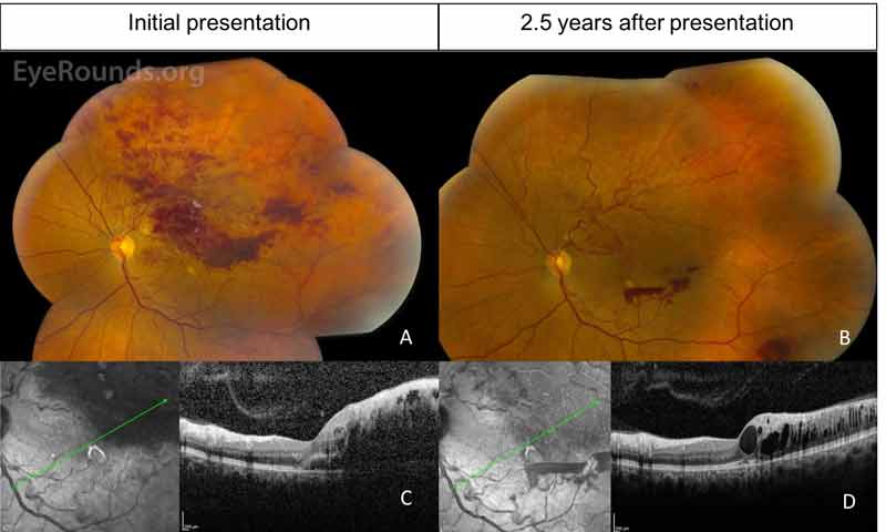 Color fundus photography, left eye: A. At her initial presentation to UIHC, there was a recurrent superotemporal BRVO along the superior arcade with massive intraretinal and retinal nerve fiber layer hemorrhages. B. At her most recent visit 2.5 years later, there were scattered intraretinal hemorrhages in the macula in addition to regions of NV in the superior macula and preretinal hemorrhages temporally and inferotemporally. Superotemporal sclerotic vessels were present. There was an area suspicious for an inferotemporal retinal arterial macroaneurysm in the mid-periphery. C-D. OCT showed improvement of subretinal fluid, but there was still persistence of intraretinal fluid when comparing the initial (C) and most recent (D) OCT images. The persistent of fluid with new NV was likely a result of the patient missing several appointments.