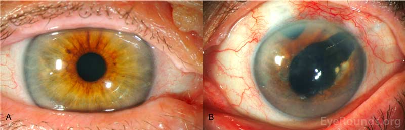 Slit lamp photography, OU. A: Slit lamp photo of the right eye shows no corneal or iris abnormalities. B: Slit lamp photo of the left eye shows corneal clouding secondary to diffuse stromal edema and bullous keratopathy. Multiple fine nodules distributed over the inferior 180 degrees; see Figure 4 for higher magnification of these nodules. Superotemporal Baerveldt seton with underlying surgical sector iridectomy in addition to avascular blebs superiorly and temporally from prior trabeculectomies. The patient was pseudophakic OU.