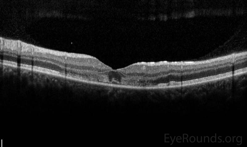 Optical Coherence Tomography (OCT) of OD (upper image) and OS (lower image) three days after initial presentation. In both eyes, there was a parafoveal band of hyperintensity in the outer nuclear layer, outer plexiform layer and inner photoreceptor segments/outer photoreceptor segments junction. There was disruption of the inner segment/outer segment junction subfoveally OU. 