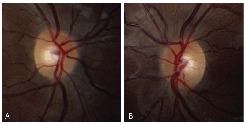 Fundus photography of the right eye (A) and left eye (B) at final presentation showing trace disc edema of both optic nerves following treatment. There were no peripapillary folds or coarsening of the retinal nerve fiber layer (RNFL).