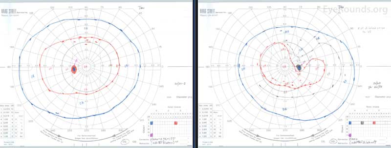 Pre-operative Goldmann visual fields demonstrated a superotemporal constriction of the I2e and I3e isopters with baring of the blind spot in the right eye and a full visual field in the left eye.