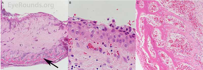 Surgical pathology of sinus tissue. Panel A: Wall of mucocele with thick edematous submucosal tissue beneath the epithelial lining. Arrow points to reactive new bone formation. 40X magnification. Panel B: Mucosal surface of mucocele with squamous metaplasia of the lining. Residual respiratory epithelial cell lining is present as surface cells containing pale blue-staining mucin. 600X magnification. Panel C: Reactive bone formation with numerous osteoblasts lining the newly formed trabeculae. 200X magnification