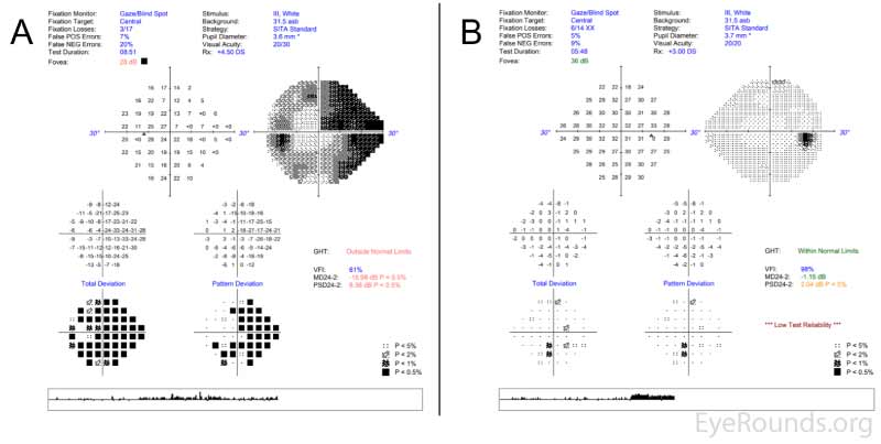 Central 24-2 Humphrey visual field testing of (A) the left eye, which shows diffuse visual field constriction and a pronounced superonasal deficit involving central fixation, and (B) the right eye, which shows mild, nonspecific defects.