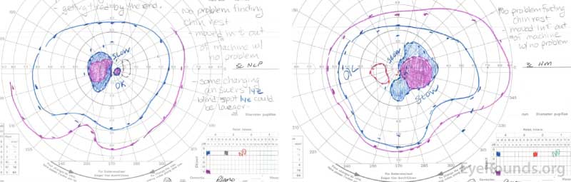 Goldmann Perimetry