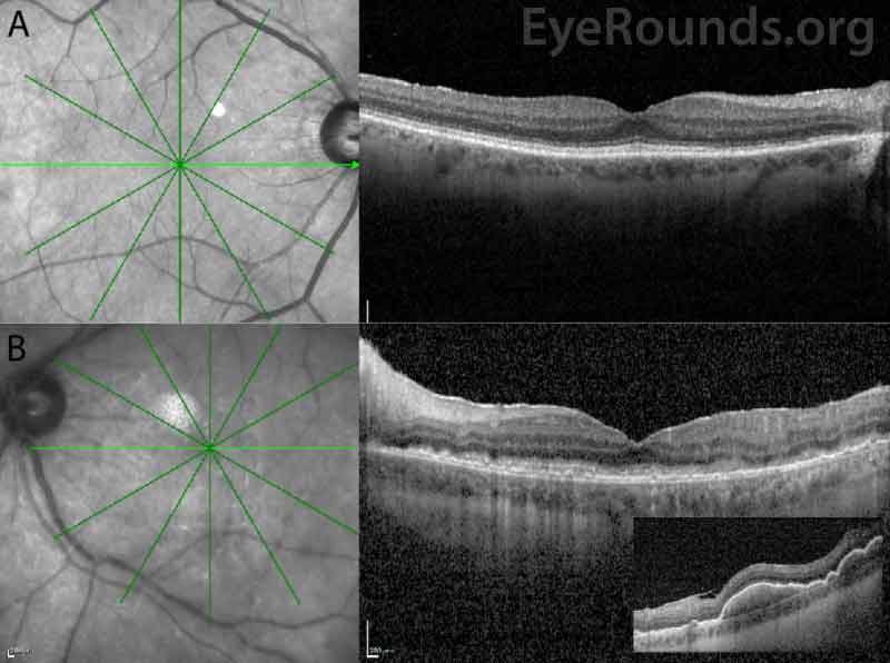 SD-OCT of the macula 