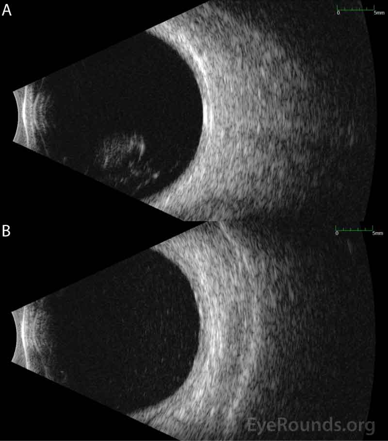  Ocular echography 