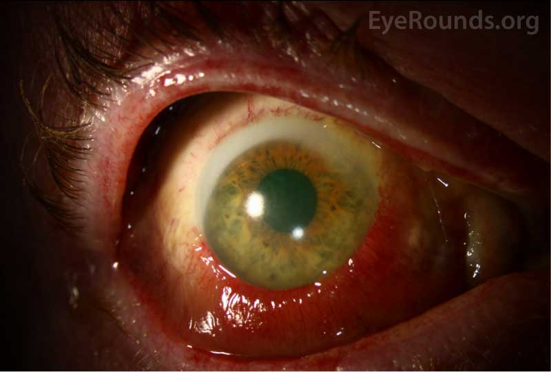  External photo of the left eye demonstrates subconjunctival hemorrhage and chemosis extending from 2:30 clockwise to 9 o’clock
