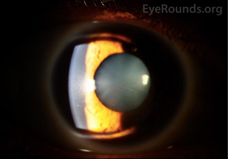  Anterior segment photography of the right eye, two months after starting treatment showing improved stromal opacification and neovascularization in the affected area inferonasally. 