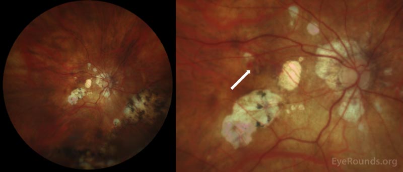 Clarus color fundus photograph of the right eye. There is a subtle hemorrhage in the superotemporal macula overlying an area suspicious for a lacquer crack (arrow). The fundus demonstrates many signs characteristic to high myopia including a tilted disc, peripapillary atrophy, and macular atrophy. There are chorioretinal scars in the inferonasal periphery.
