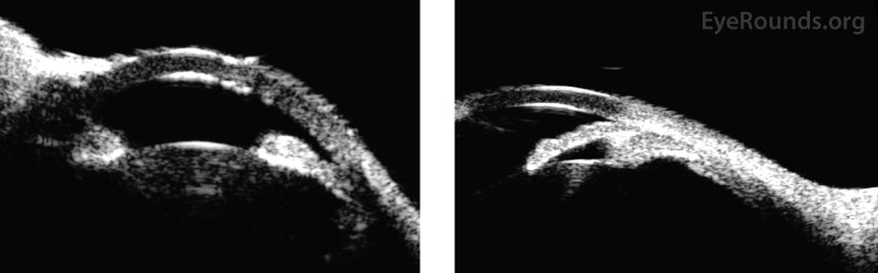  UBM of the right eye (left panel) and left eye (right panel) showing a normal ciliary body with thickened sclera.