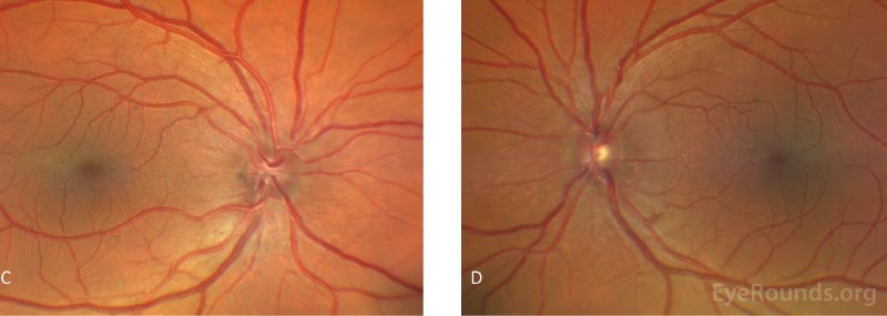  Fundus photography of the right eye (C) and the left eye (D).