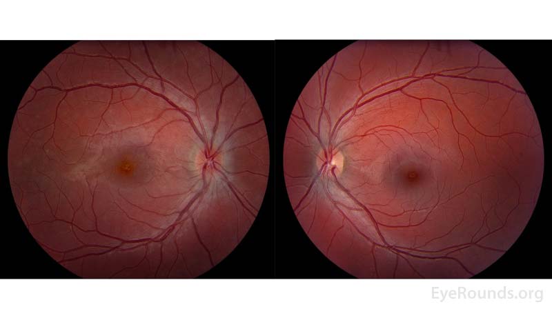 Color fundus photos of the right eye (left panel) demonstrated a small, structurally congested optic disc with mild optic disc edema in addition to an orange granular appearance of the macula.