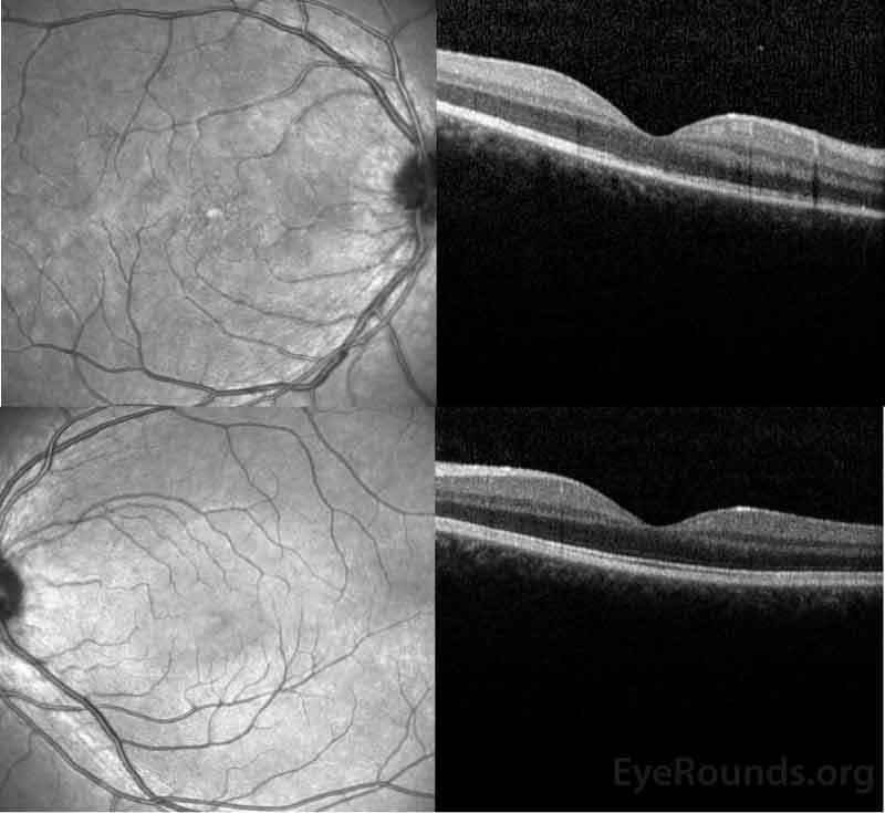 OCT of the right eye (top panel) shows a subtle stippled inner segment/outer segment (IS/OS) junction and normal foveal contour without edema.