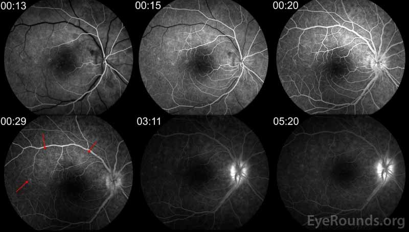 Fluorescein angiography of the right eye demonstrates multiple small foci of early and late hyperfluorescence in a wreath-like pattern (red arrows) corresponding to the lesions seen on FAF.