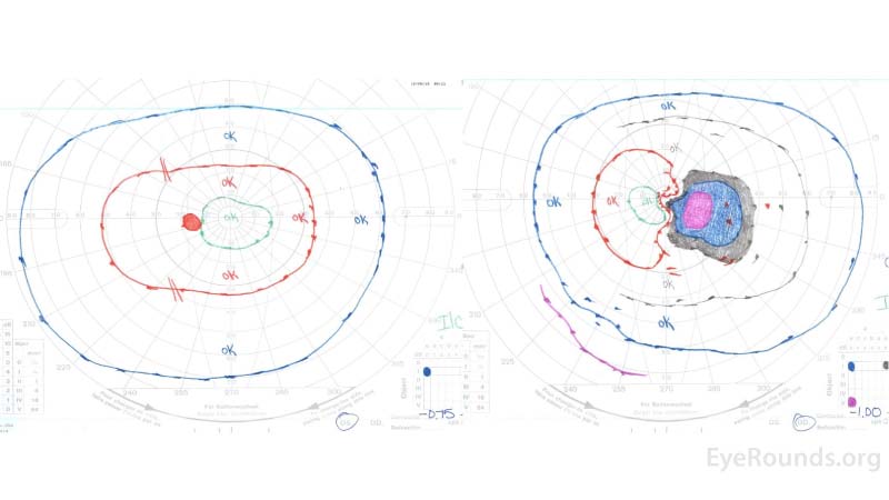 Goldmann visual field of the right eye (right panel) revealed a markedly enlarged blind spot with cecocentral scotoma at the time of presentation.