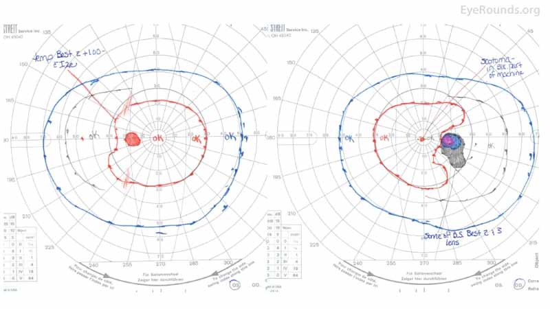 GVF of the right eye (right panel) Goldmann visual field demonstrates a markedly enlarged blind spot, while the left eye (left panel) is full.