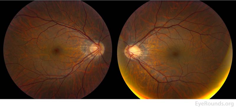 Color fundus photography of the right eye (left panel) shows subtle foveal granularity and the left eye is normal (right panel).