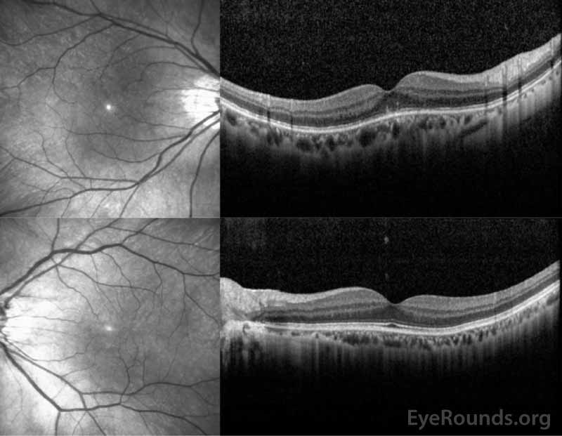 OCT of the right eye (top panel) shows a normal retinal contour but with focal hyperreflective abnormalities in the outer retina disrupting the ellipsoid zone centrally. The left eye (bottom panel) demonstrates normal retinal contour and striations.