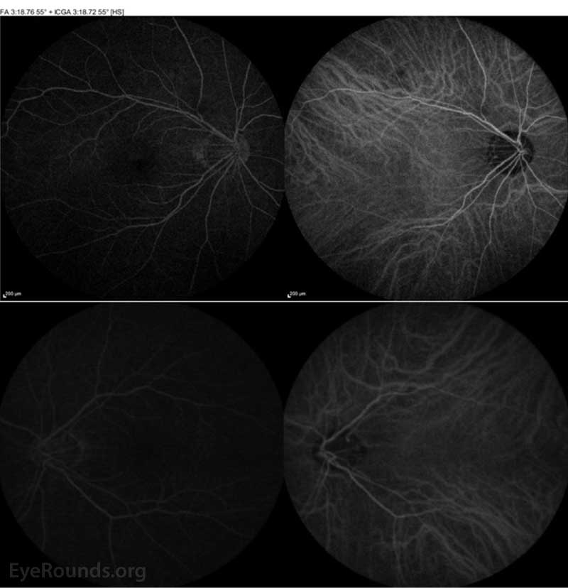 ICGA of both the right eye (top panel) and left eye (bottom panel) were normal.