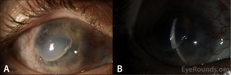 3-weeks after surgical intervention demonstrating transversing pannus and stable severe thinning from 12:30 to 9:00 with an overhanging edge and adjacent flap of non-thinned cornea