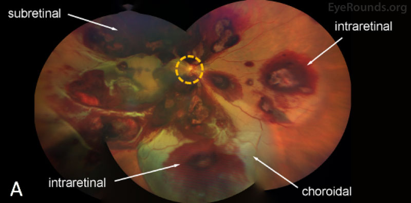  Color fundus photography OD