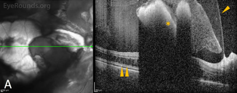 OCT images through the macula demonstrate the location and extent of the multilayered hemorrhages. Images of the right eye (A) show a tented posterior hyaloid (arrowhead), with hyperreflective sub-hyaloid hemorrhage (asterisk) and thin subretinal fluid (double arrowhead).
