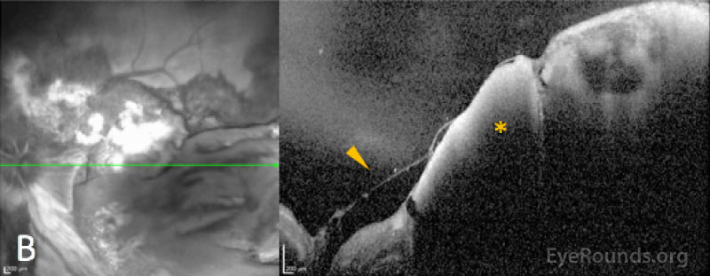 OCT images through the macula demonstrate the location and extent of the multilayered hemorrhages. the left eye (B) show a partially separated hyaloid (arrowhead) with a large sub-internal limiting membrane (ILM) component of the hemorrhage. 