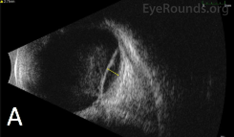   Scan ultrasound in the longitudinal position OD