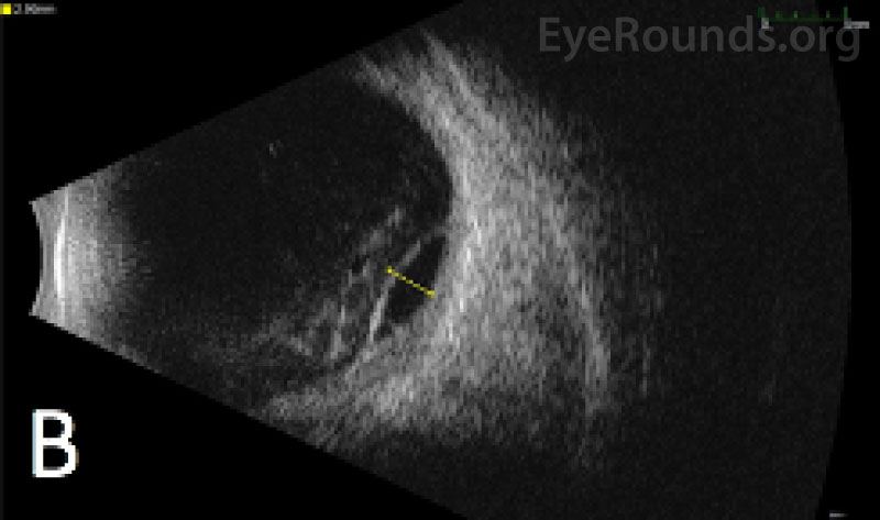 B Scan ultrasound in the longitudinal position shows vitreous opacities and subretinal versus suprachoroidal hemorrhage bilaterally two months after initial presentation. 