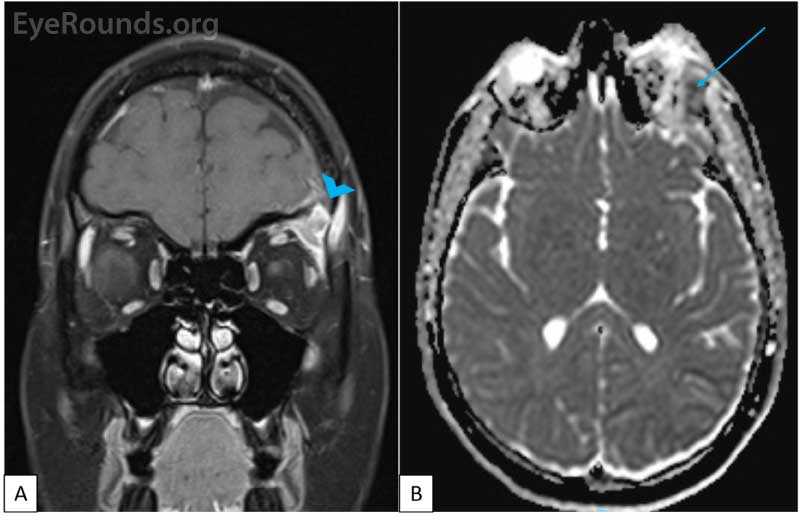  MRI of brain and orbit with contrast