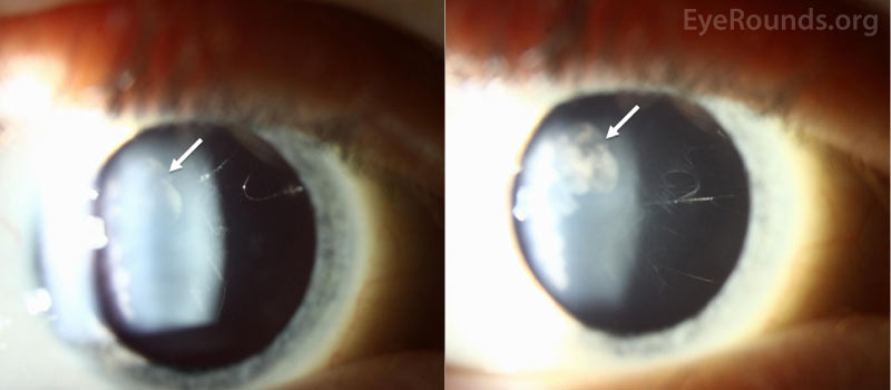  empty central vitreous with superior retrolental membranes (white arrows) and thin vitreous strands (as seen in Type I Stickler syndrome)