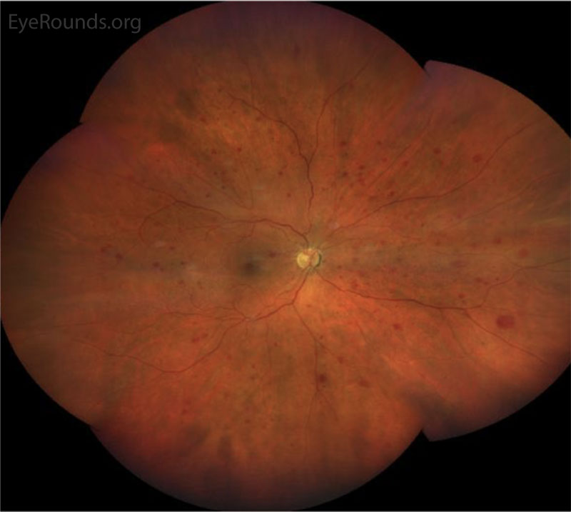 Montage wide-field fundus photograph of the right eye showing a clear view through the vitreous.