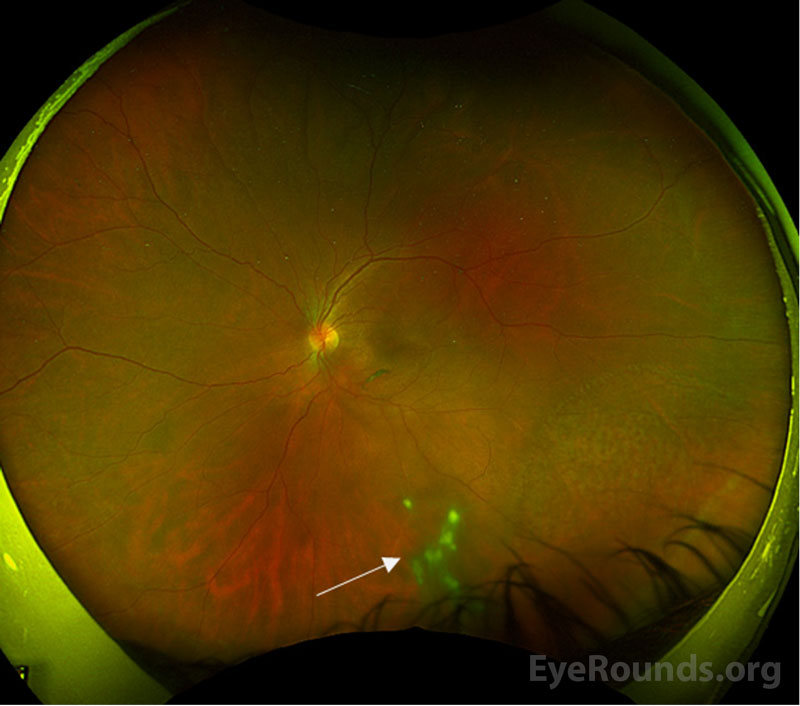  Color fundus photo of left eye at presentation demonstrating vitreous cell and floaters with snowballs inferiorly