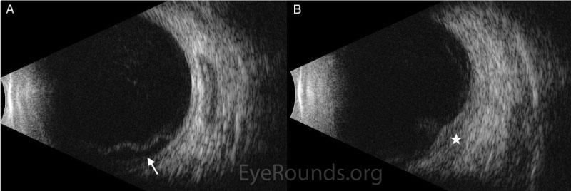 Standardized ocular echography of the left eye.