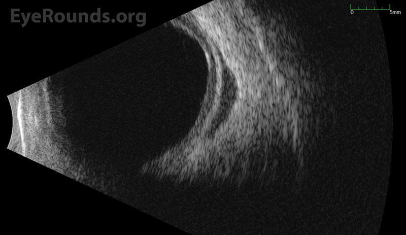 B-scan ocular ultrasound OS