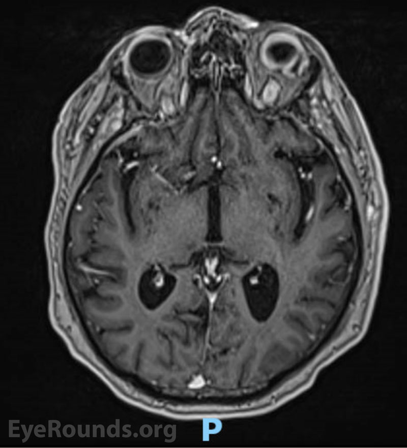 T1-weighted MRI