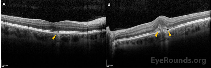 Spectralis optical coherence tomography, OU