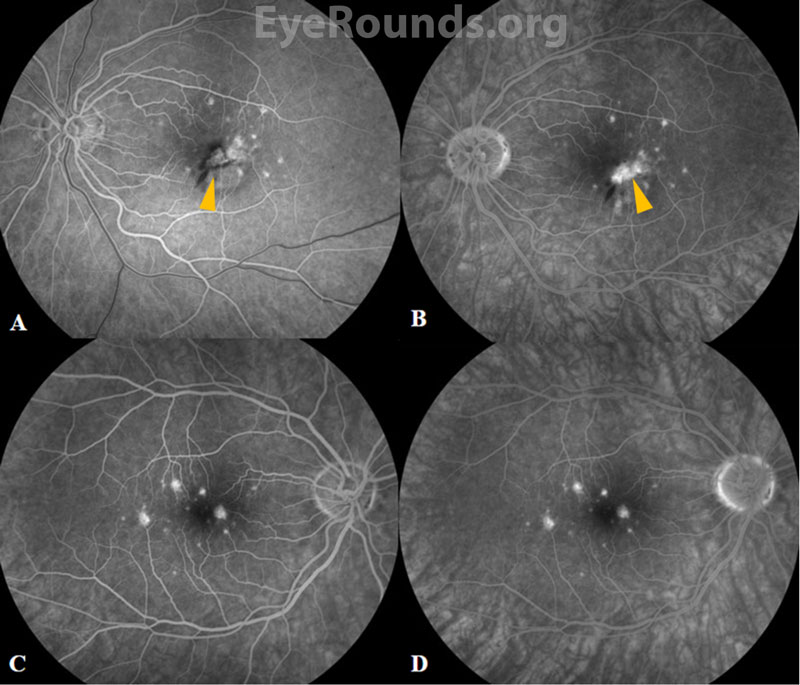 Clarus fundus fluorescein angiography, OS