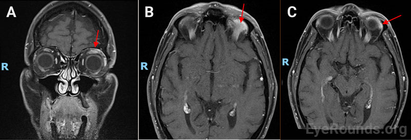 T1-weighted fat-suppressed post-contrast MRI coronal section (A) and axial section (B and C) demonstrated enlargement of the left superior rectus, levator palpebrae superioris and lacrimal gland.