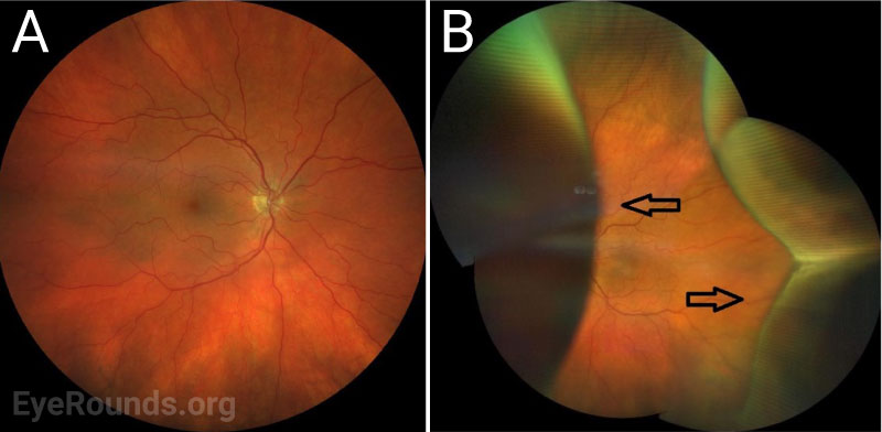 Clarus widefield color fundus photography. A) OD with clear media, mild vascular tortuosity, and a normal visible periphery. B) OS with clear media, mild vascular tortuosity, and prominent serous choroidal effusions (black arrows).