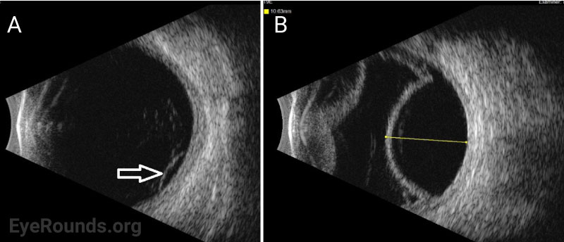 Standardized ocular echography, T9E view. A) OD with mild to moderate vitreous opacities in total PVD and shallow retinoschisis (white arrow). B) OS with mild vitreous opacities, serous choroidal effusion measuring 10.63 mm thick (yellow line), and small amount of inferior subretinal fluid.