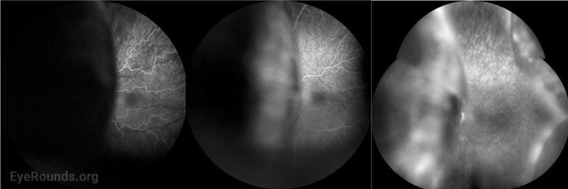 Clarus widefield fundus fluorescein angiography, OS showing a few microaneurysms but no vasculitis or findings suggestive of bullous central serous chorioretinopathy.