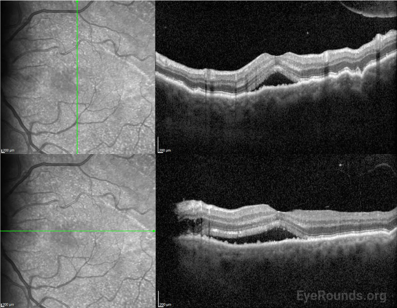 OCT macula showing choroidal folds and subfoveal subretinal fluid with mild intraretinal fluid adjacent to optic nerve head.