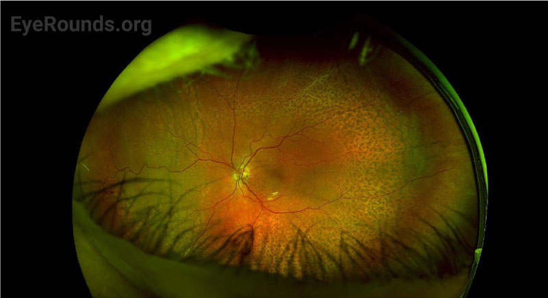 Optos widefield pseudocolor fundus photography OS eight months after scleral window surgery showing diffuse subretinal pigmented deposits with a “leopard spot” pattern throughout the fundus. The choroidal effusions are nearly resolved.