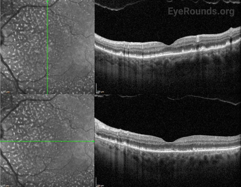 OCT macula OS eight months after surgery shows scattered high-reflective subretinal deposits and no subretinal fluid.