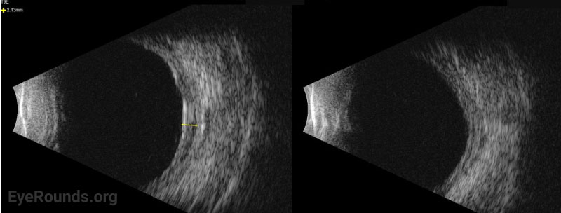 Standardized ocular echography OS eight months after surgery, T9E view (A) and T3E view (B) showing a very shallow choroidal effusion (2.13 mm nasally) and no retinal detachment