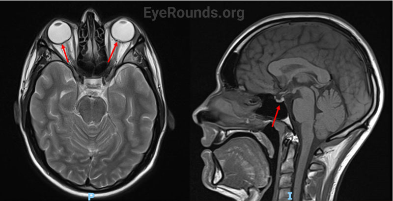 MRI of the brain without contrast. Prior to presentation, MRI revealed globe flattening in an axial view (left panel, red arrows) and a partially empty sella in saggital view (right panel, red arrow). 