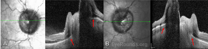 Optical Coherence Tomography (OCT) of the optic nerve head in the right (A) and left (B) eyes.
