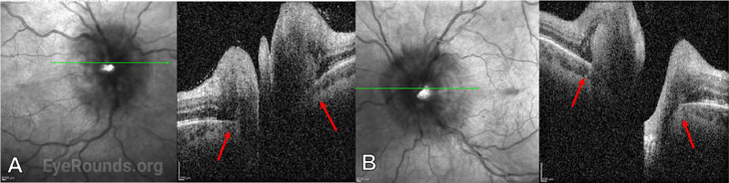 OCT of the right (A) and left (B) eyes following lumbar puncture and intitiation of treatment for Cryptococcal meningitis. 