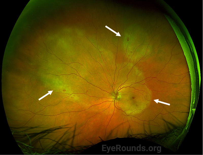 Optos color fundus photography of the left eye at initial visit demonstrating regions of placoid retinal opacification involving the macula and the nasal mid-periphery, with a second, smaller region of opacification superotemporally in the mid-peripheral retina (white arrows)